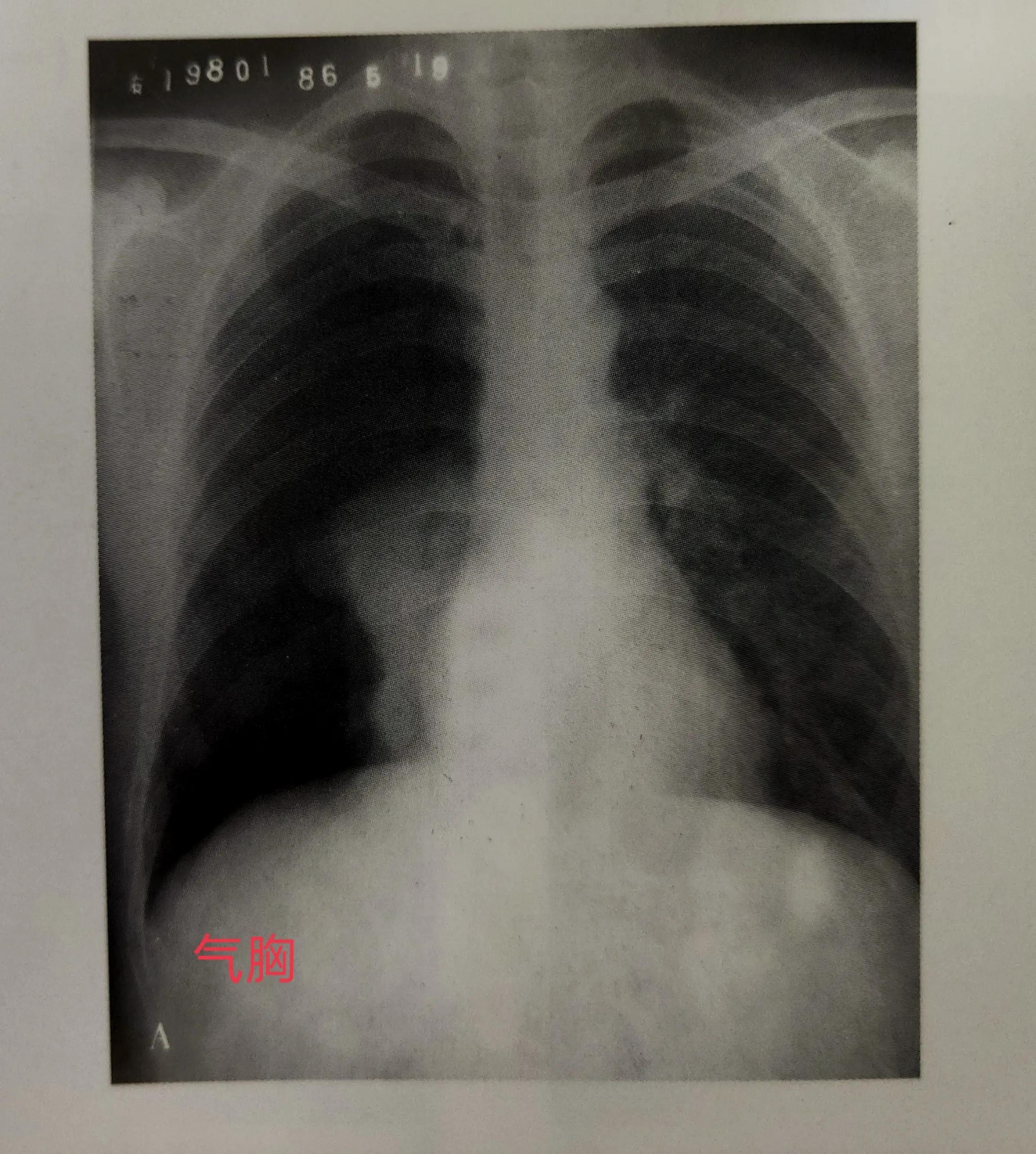 学习《X线读片指南》第一节X线成像的基本原理