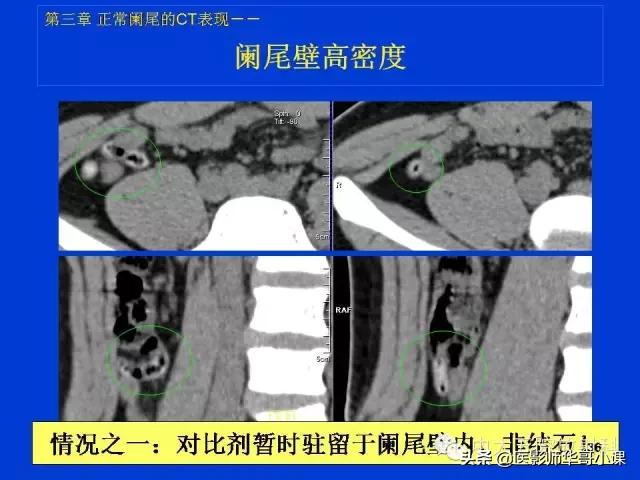 阑尾炎课件,阑尾炎的超声课件