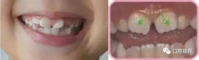 听说牙缝太大难看又露财，您给看看这牙缝还有救吗？