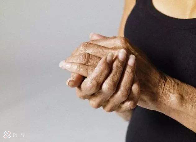 赋能间充质干细胞治疗类风湿,类风湿关节炎最新研究干细胞