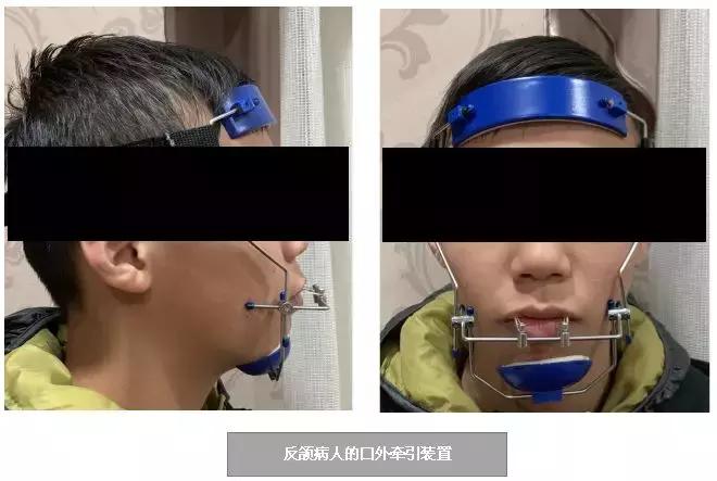 口呼吸变丑矫正需要多久,长期口呼吸会嘴凸吗