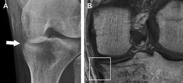 放射科夜班病例大全,放射科容易漏诊的骨折