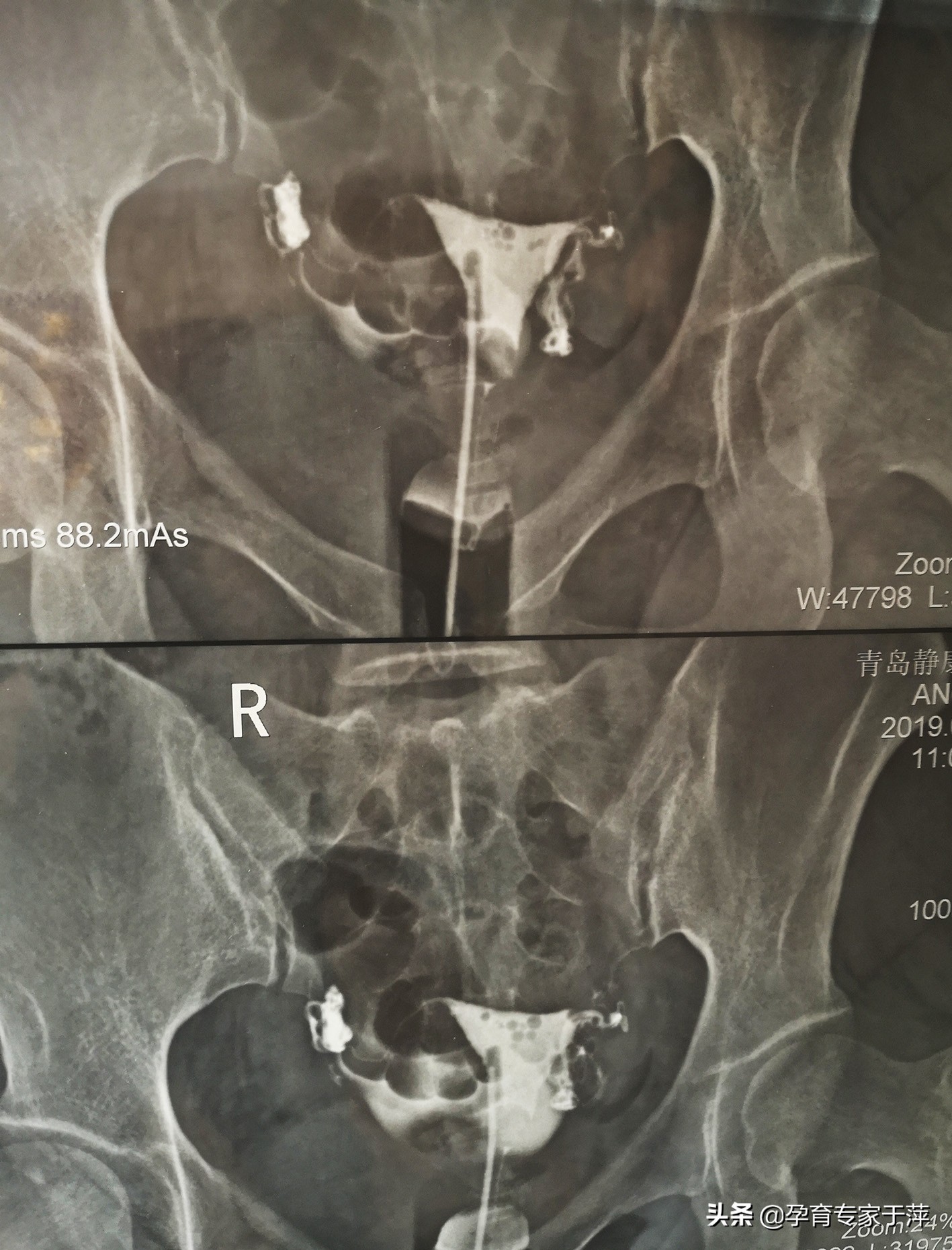 青岛助孕专家于萍：输卵管不孕、多囊，综合治疗喜怀孕