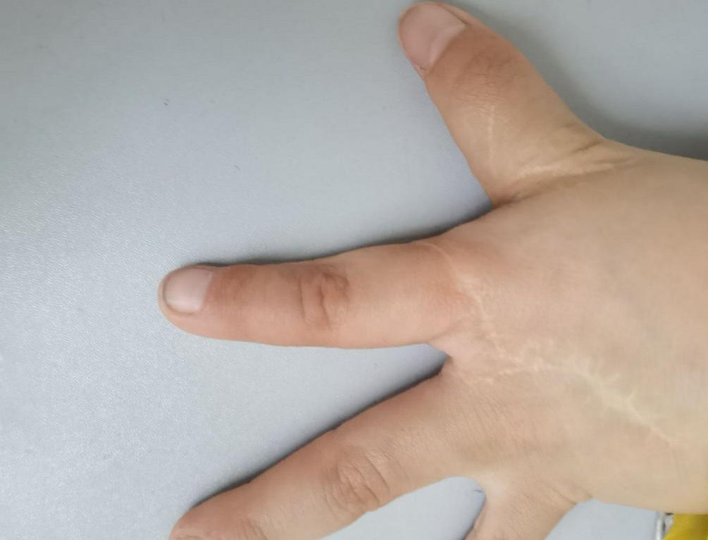 并指畸形免植皮案例,并指畸形