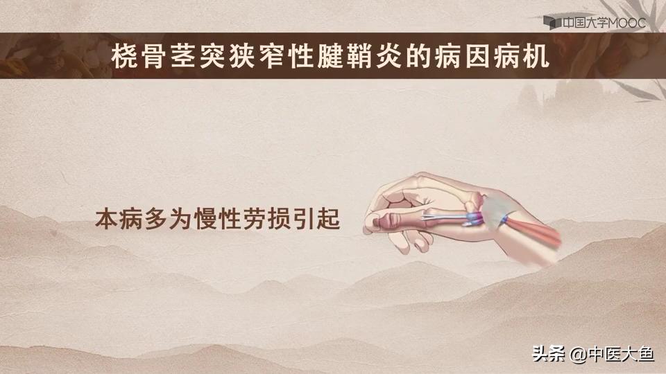 桡骨茎突狭窄性腱鞘炎怎么治疗,桡骨茎突狭窄性腱鞘炎治疗方法