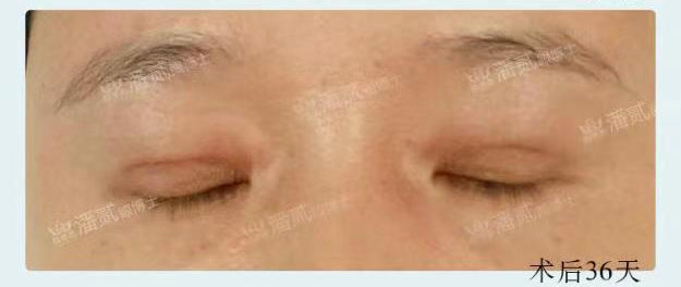 眼皮填充的脂肪凹凸不平怎么办,上眼皮凹陷填充脂肪有危险吗