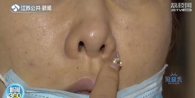 女子隆鼻拆夹板歪了,施尔美整形医院鼻综合