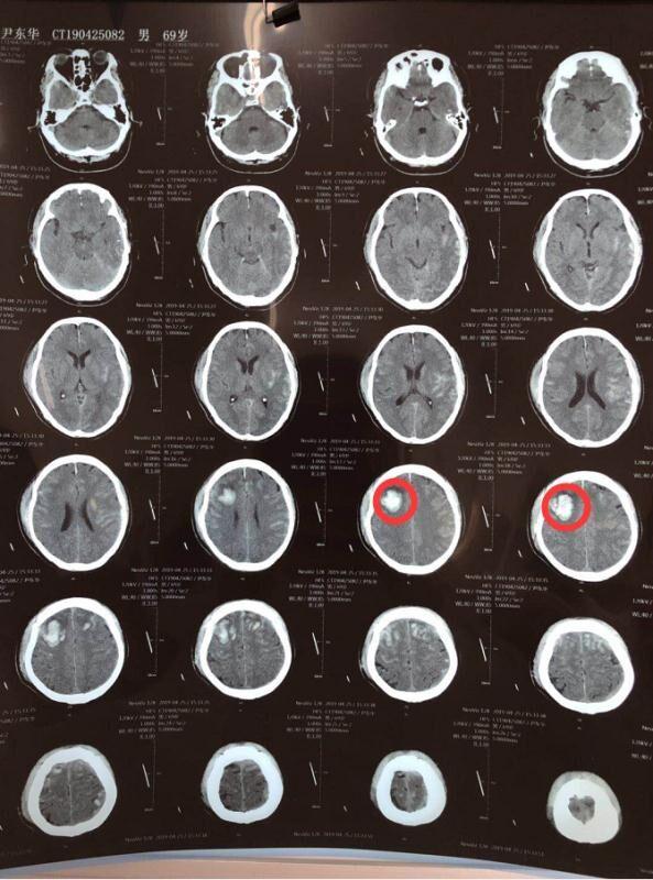创伤救治中心——沈医二院多学科通力合作又一次成功救治严重车祸多发伤患者