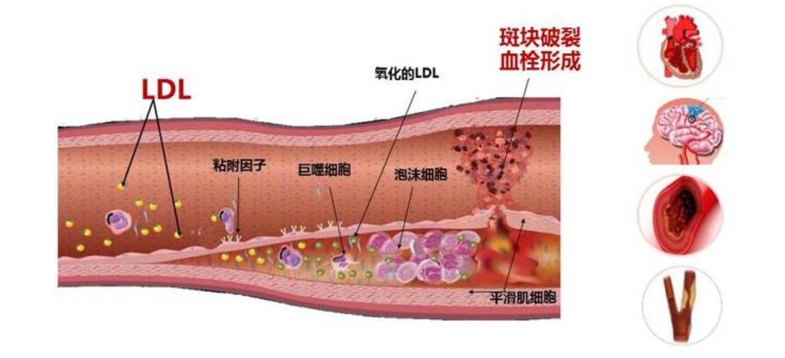 高血压控制不好将导致严重后果,高血压控制不好引起颈动脉斑块