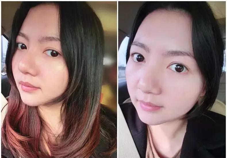 脸上长痘痘的原因和注意事项,脸上长痘痘到底应该怎么解决