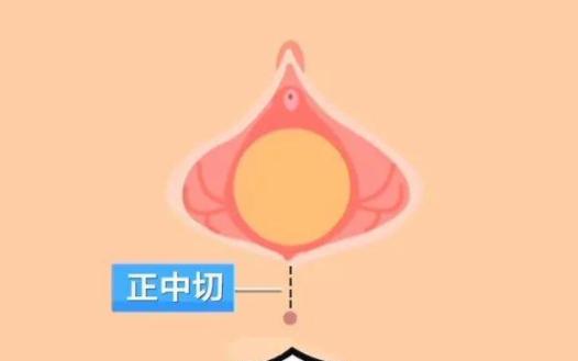 侧切是因为孩子太大吗,侧切为什么要留一点不缝