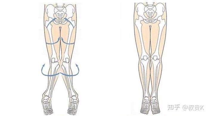小腿不直该怎么办,小腿不直肌肉外翻怎么办