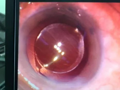 胶南高度近视白内障手术,烟台毓璜顶眼科白内障哪个大夫好