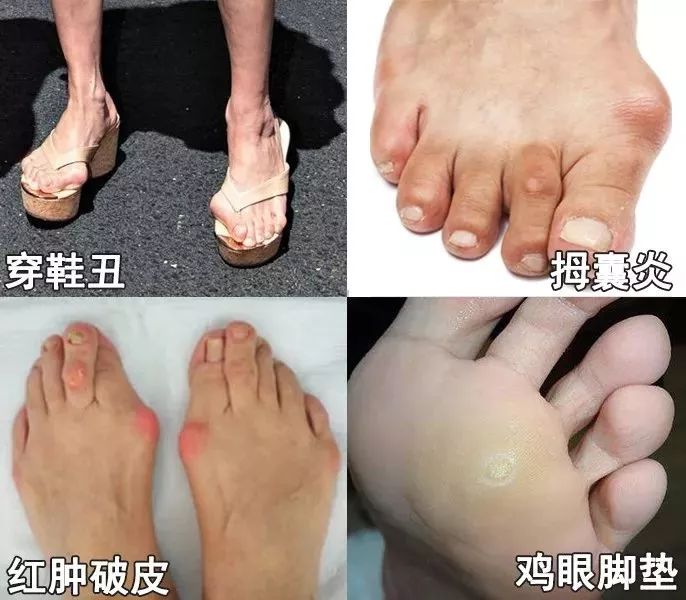 脚趾超级痛,轻度脚趾外翻如何矫正