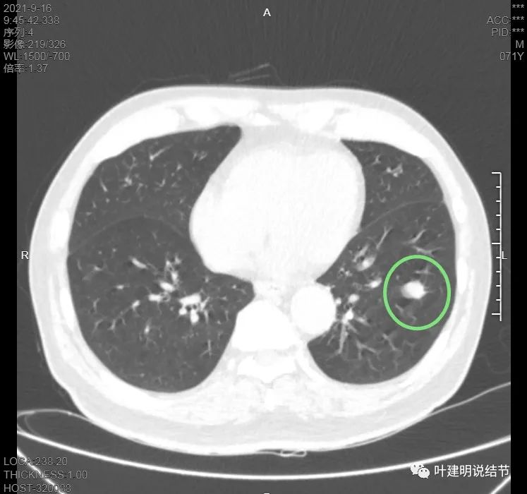 肺上有实性结节6mmx5mm是什么原因,肺上有1.7x1.8的实性结节该怎么办
