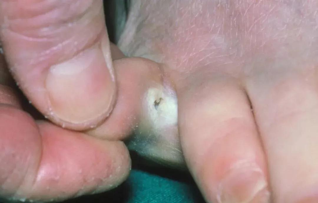 天气一热脚就脚臭?教你5招,远离脚气