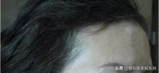 超声刀对皮肤有伤害吗,超声刀做的是哪一层的皮肤