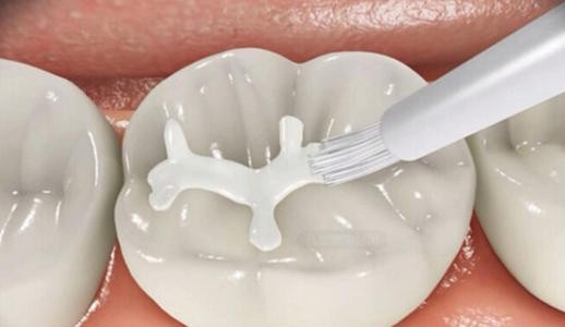 小孩全部蛀牙都需要补吗,9岁孩子蛀牙需要补牙吗