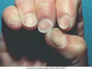 指甲显示的疾病,指甲上的各种疾病图片