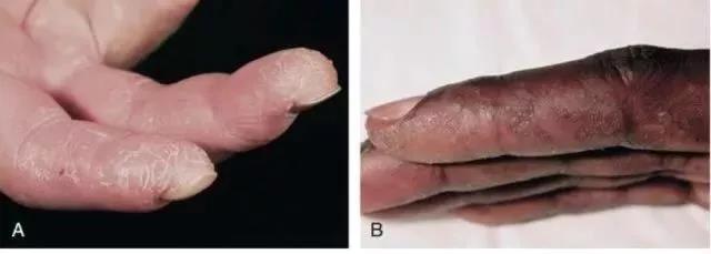 皮肌炎或多发性肌炎的诊断标准,成人皮肌炎与儿童皮肌炎区别