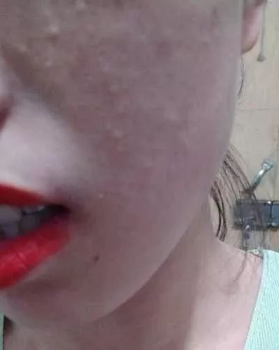 逆光疹是属于皮肤炎症吗,逆光疹是不是日光性皮炎