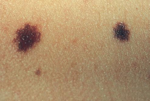 痣长在什么地方易癌变,痣几乎人人都有什么样的痣会恶变