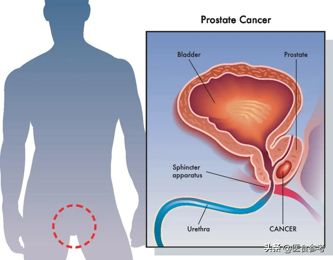 纵欲的后果有多可怕？无论男女，这都是导致性癌的祸根