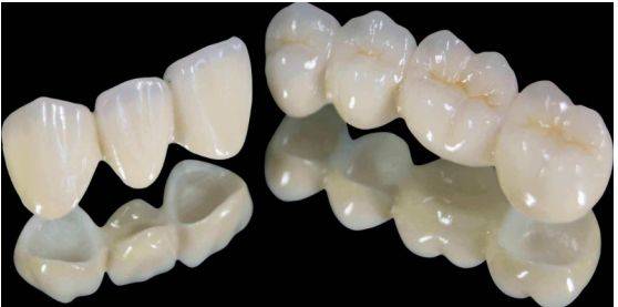 一个月工资种牙,一年工资不够种牙