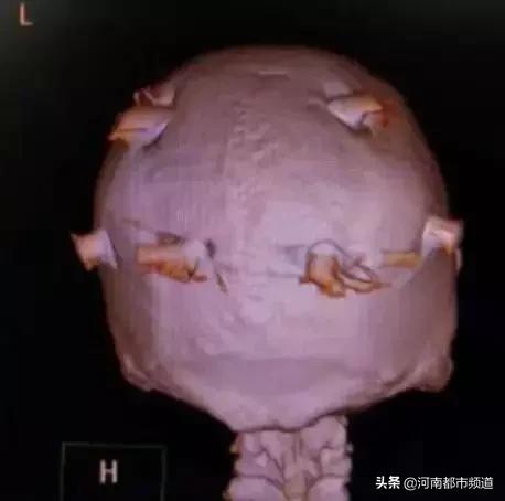 小伙反复头晕查出脑瘤,男子持续头痛竟是脑内有炸弹