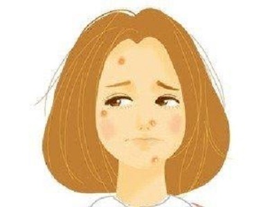 脂溢性皮炎的预防和护理方法,脂溢性皮炎恢复期该怎么护理