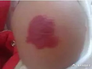 婴儿尿布湿疹的最快自愈方法,婴儿湿疹痤疮尿布疹