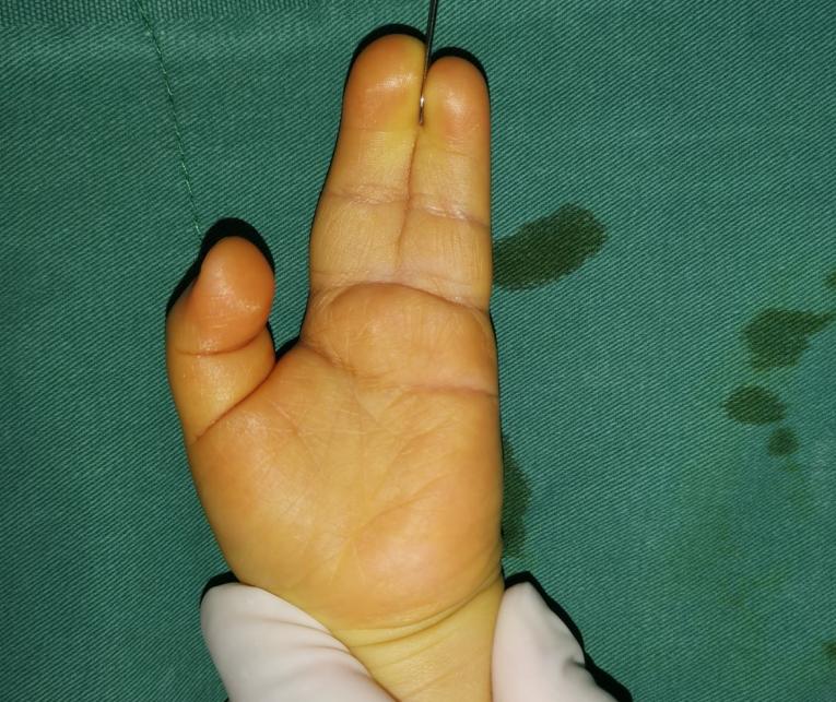 并指畸形免植皮案例,并指畸形