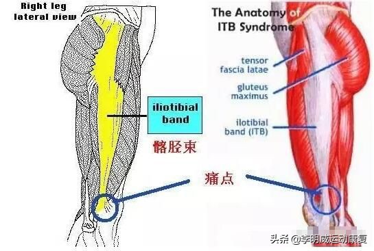 膝盖外侧疼痛，光放松髂胫束可不行！
