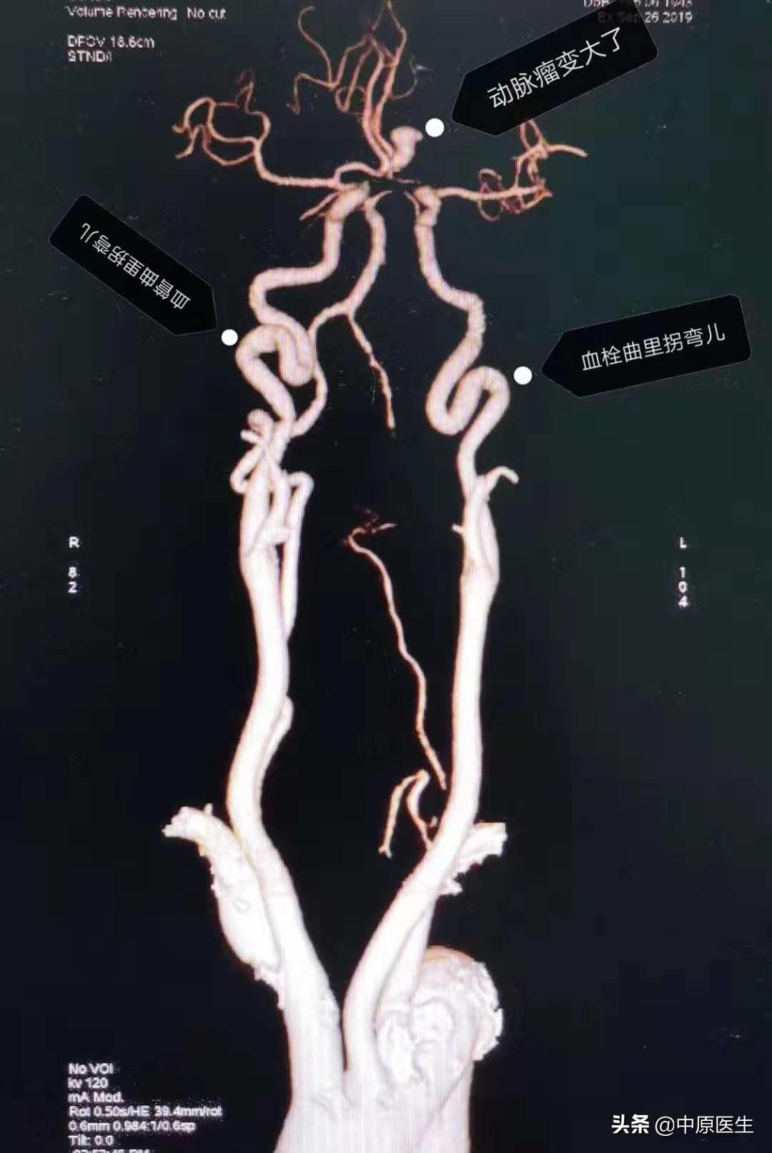 大脑双侧动脉瘤,发现脑内有两个瘤医生说不管