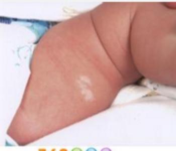 小孩身上有一块白斑怎么回事,身上有一块白斑汗毛也是白的