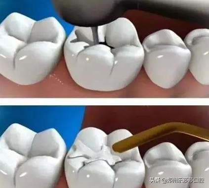 你以为有龋齿补牙就可以了？不，你还要做到这些才行