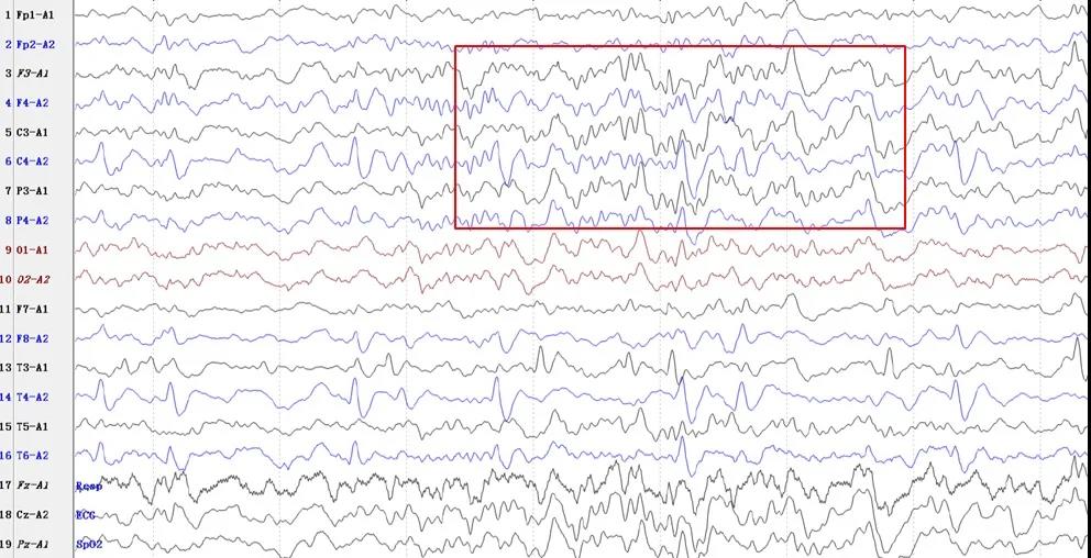 对诊断癫痫最有帮助的检查是,癫痫排查高频脑电波