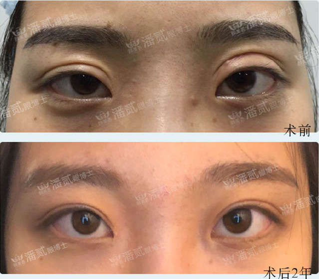 双眼皮修复有失败的吗,双眼皮修复失败了会怎样