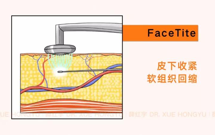 面部吸脂可以瘦脸,面部吸脂全脸什么部位不能吸