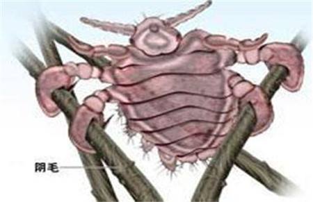辟谣:带安全套就能预防所有性病吗?错,这种性病戴避孕套也没法
