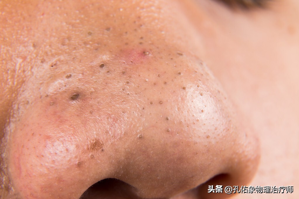 痘痘辟谣,长痘辟谣