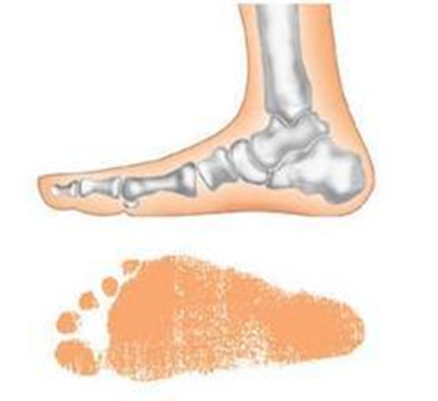 穿哪种鞋子更容易得扁平足,扁平足穿鞋难看怎么办