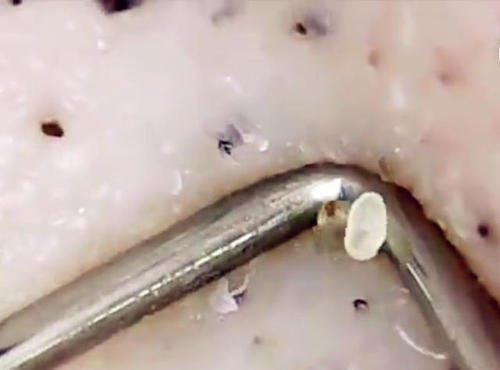 脸上挤出的小白粒是螨虫吗,挤出来的小米粒有螨虫吗