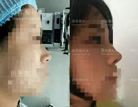 协和整形美容科专家,北京协和整形鼻综合