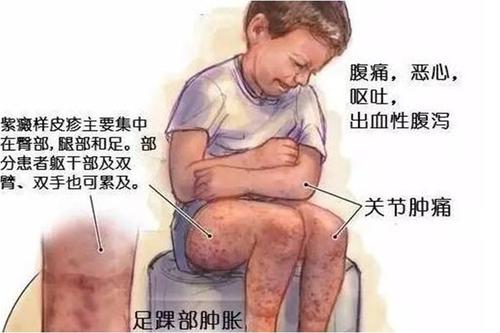 过敏性紫癜并发症有哪些,过敏性紫癜有哪些症状及危害