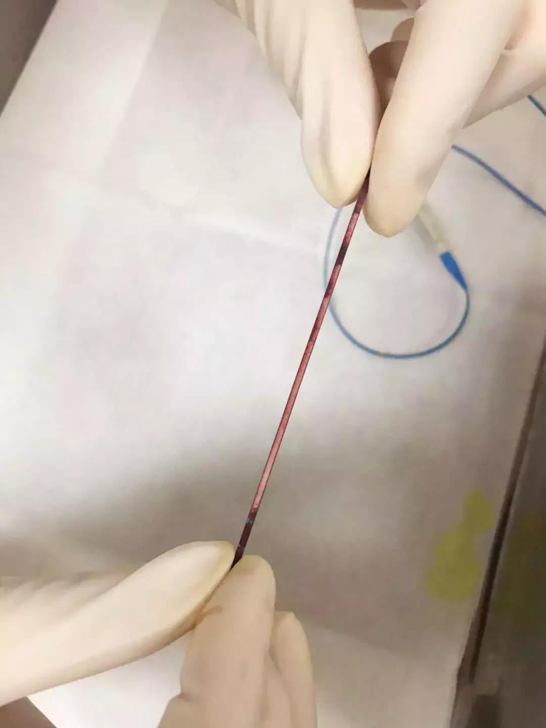 picc堵管了直接拔掉可以吗,化疗用的picc管堵了什么原因