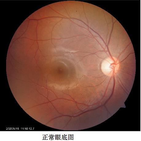 ai眼底照相机检查医院,ai技术落地眼底筛查