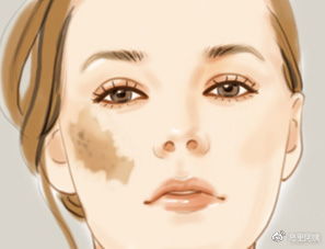 雀斑、*褐斑黄**、咖啡斑、晒斑、妊娠斑...分不清还谈什么祛斑