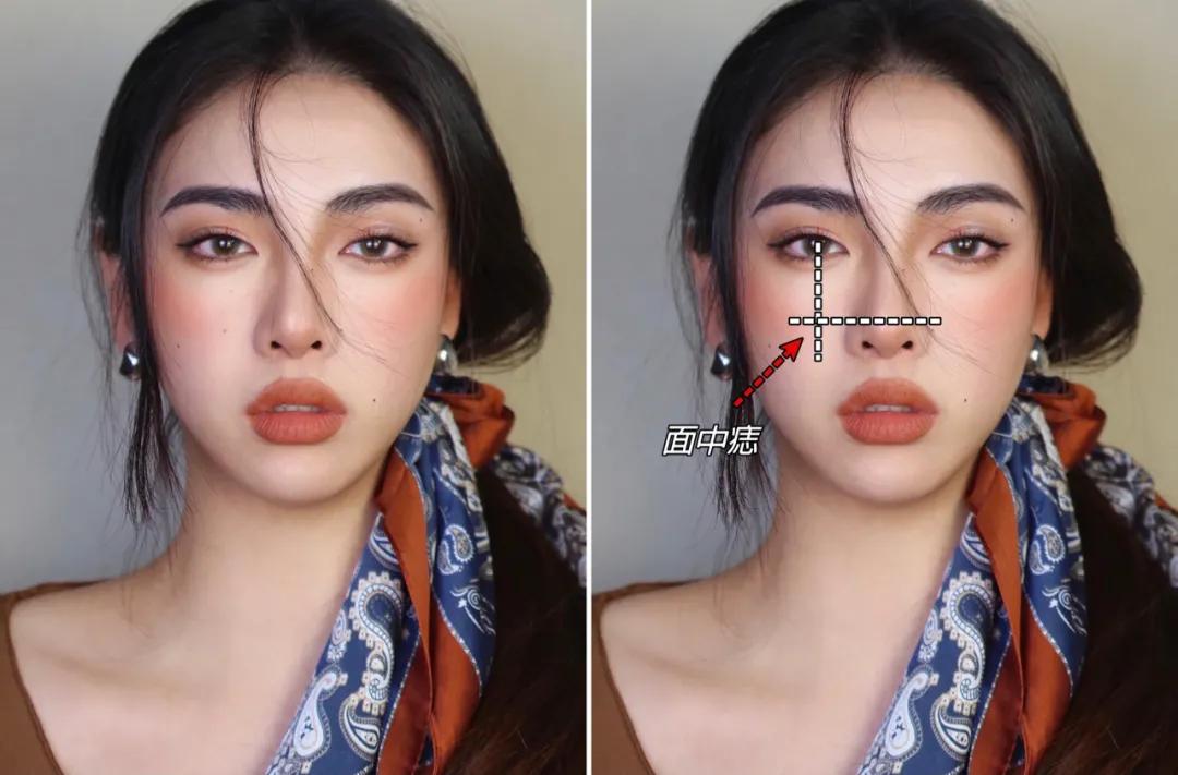 点痣就能变美,点痣整容大法