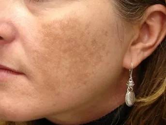 斑点美白最有效的正品祛斑霜,女士抗皱祛晒斑雀斑霜